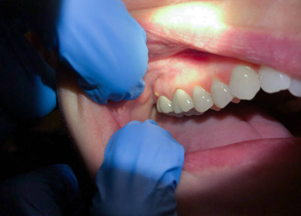 Best Emergency Tooth Extraction in Silverton, OH